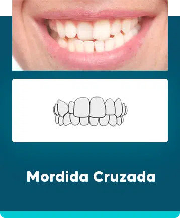 Mordida Cruzada