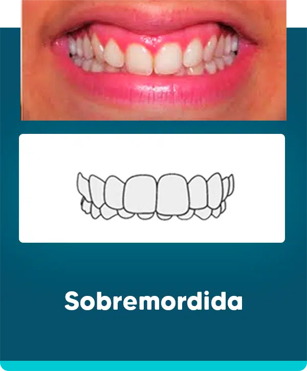 Mordida Sobremordida